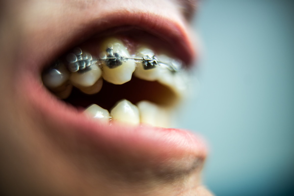 Metal Mouthpiece: The Joys of Orthodontia