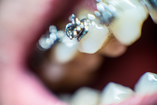 Orthodontic Appliance Close-Up