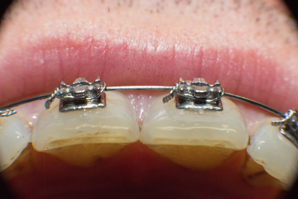 Braces: The Great Connector (of Food)
