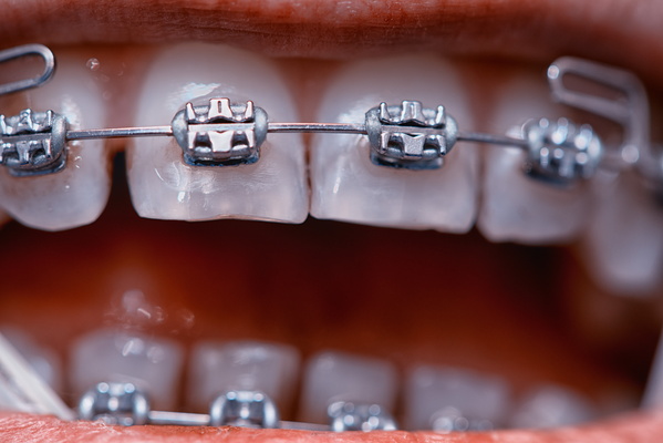 Smile Under Construction