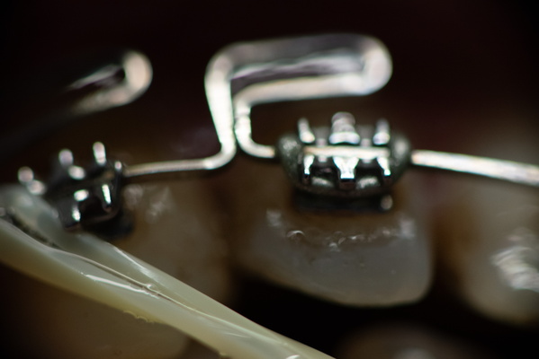 The Art of Orthodontics: Crafting the Perfect Smile