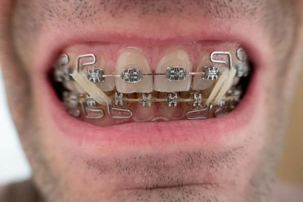 Rubber Band Adventures in Orthodontics