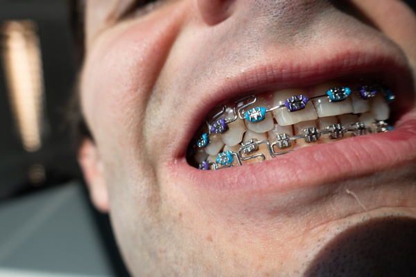 Metal and Enamel: A Symphony of Smiles