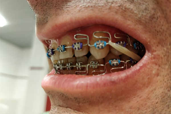 Teeth Trapped in Titanium