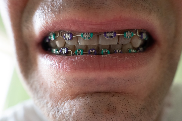 My 'Perfect' Accessory: Metal and Elastic