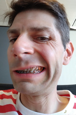 Braces of Steel, A Smile's Appeal