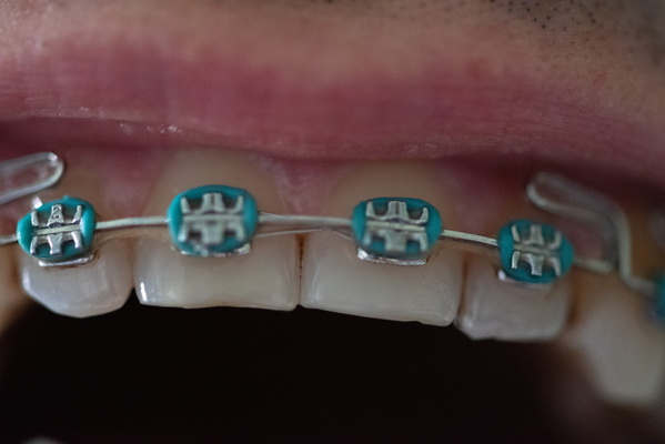 Steel Threads, Gentle Promise: A Smile's Silent Song