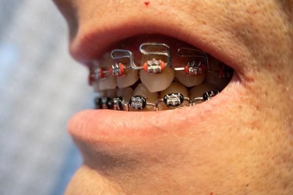 The Braces Saga: A Close-Up on My Orthodontic Adventure
