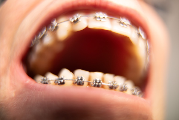 The Symphony of Metal: A Braces Fantasy
