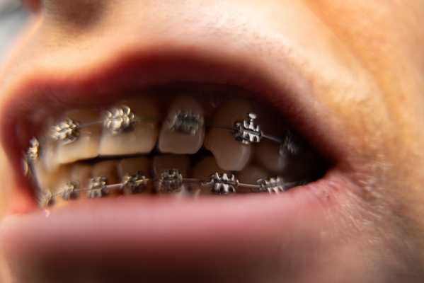 The Tiny Architects of My Occlusion: Braces in Action