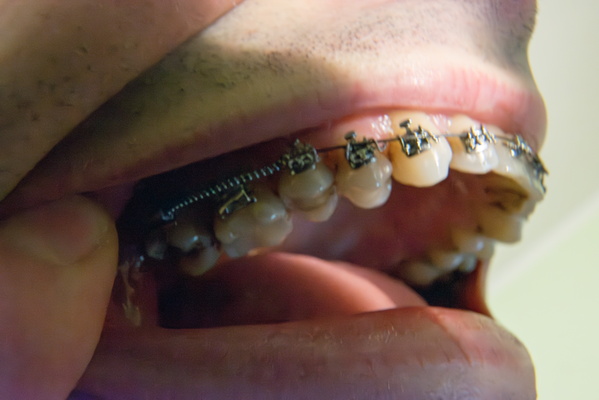 The Untold Story Behind the Braces