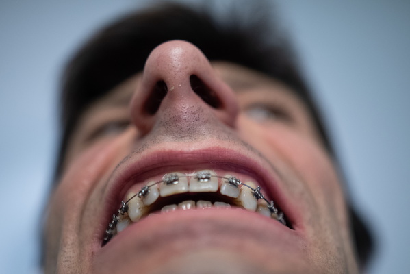 The Thrill of the Grill: My Braces Journey