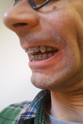 Brace Yourself: A Metal Mouth Memoir