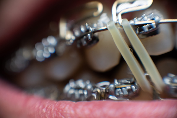 Gleaming Grills: My Fashionable Orthodontic Statement