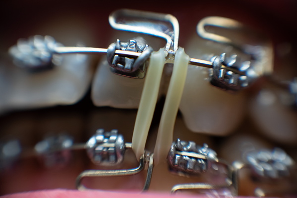 Intraoral Orthodontics: A Close-Up View
