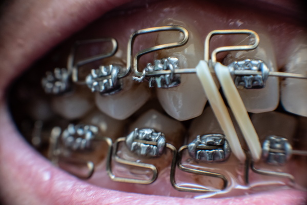 Ode to Orthodontics: My Bank Account's Greatest Foe