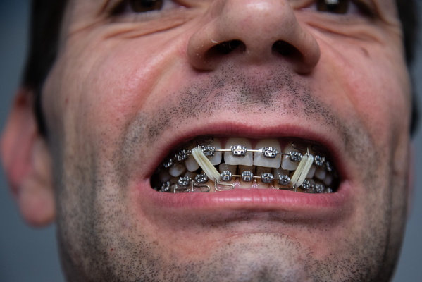 Braces Fun: A Sticky Situation
