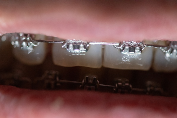 Upper and Lower Teeth with Braces