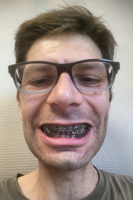 Adulthood with Braces: Braced for the Future