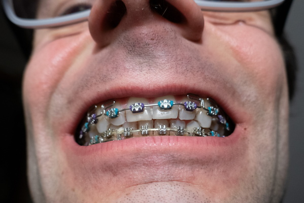 Grinning with Metal and Colour Gadgets: My Braces Story