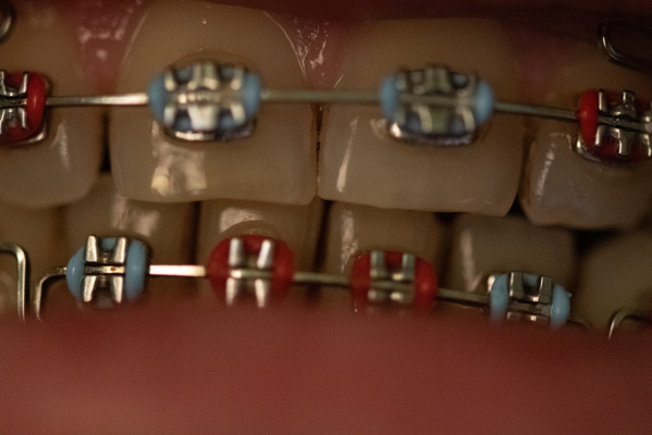 The Beauty of Braces Up Close